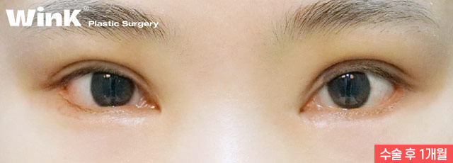 Wink canthoplasty and lower canthoplasty to overcome a cramped-looking eye shape! image 10