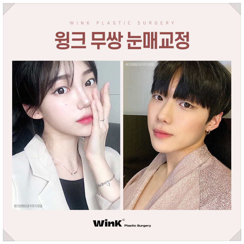 Epicanthoplasty-Free Ptosis Correction Surgery, Ptosis Surgery Without Double Eyelids, WINK Plastic Surgery, Ptosis Correction Surgery Before and After, Double Eyelid Ptosis Correction image 9