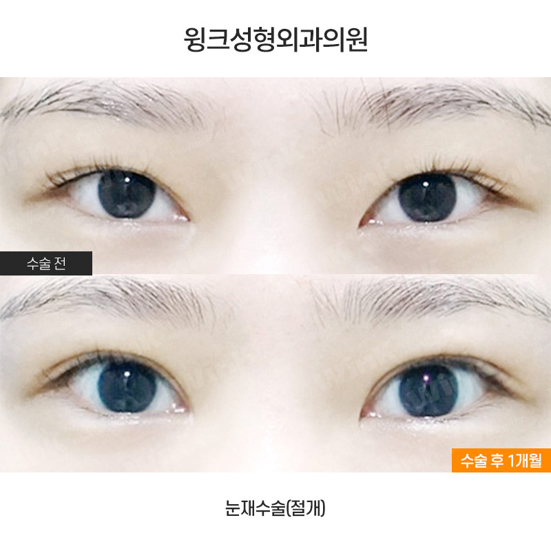 꼬막눈 쌍수도 시원하게! 눈성형 중점 진료 윙크성형외과 관련 이미지 1