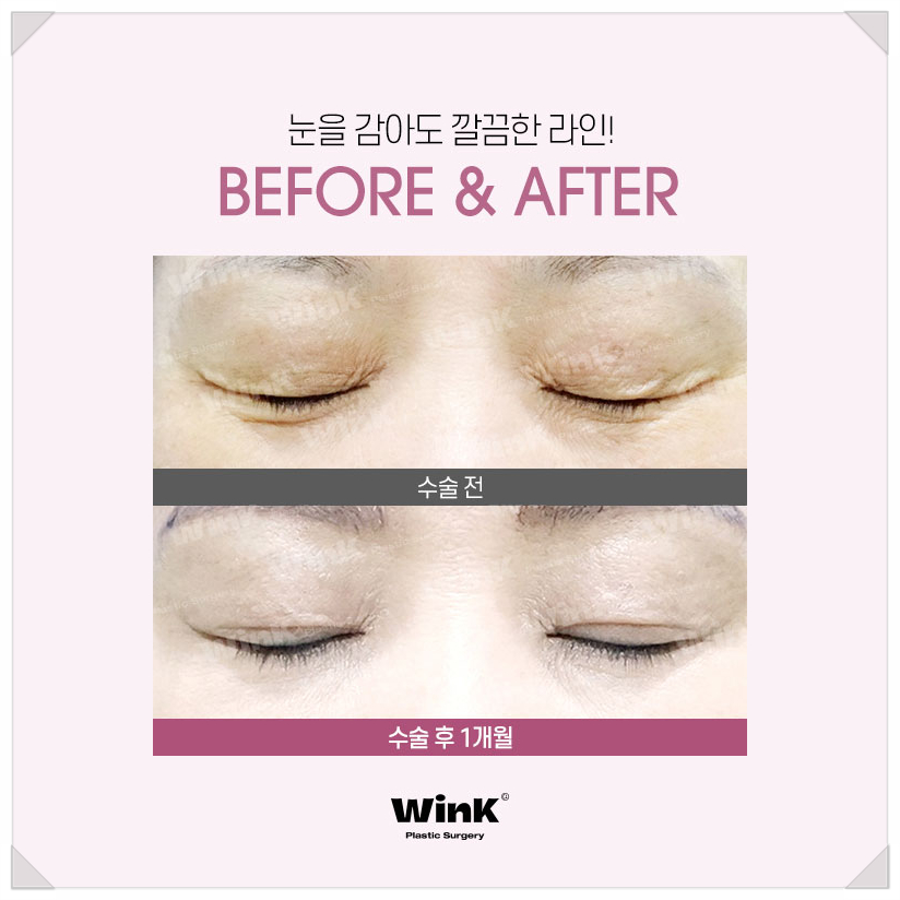 처진눈꺼풀수술 눈처짐수술 알아본다면 윙크성형외과 상안검수술 상안검수술회복기간 관련 이미지 3