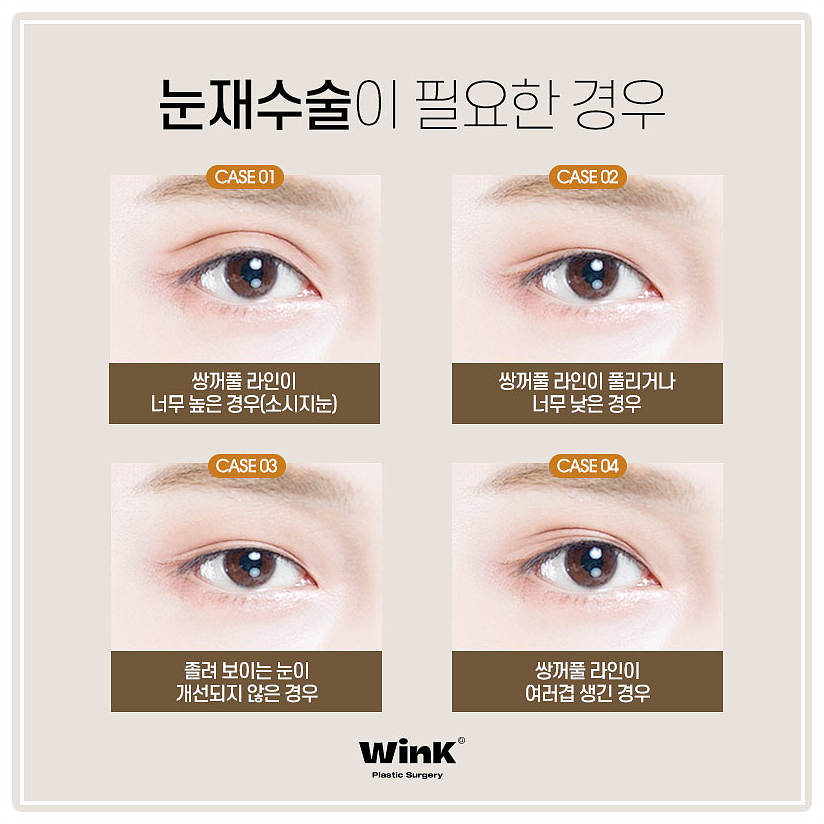 Double Eyelid Surgery Sausage Eyes, Double Eyelid Surgery Scars, Wink Plastic Surgery Double Eyelid Line Lowering, Sinsa Revision Eye Surgery Before and After image 2