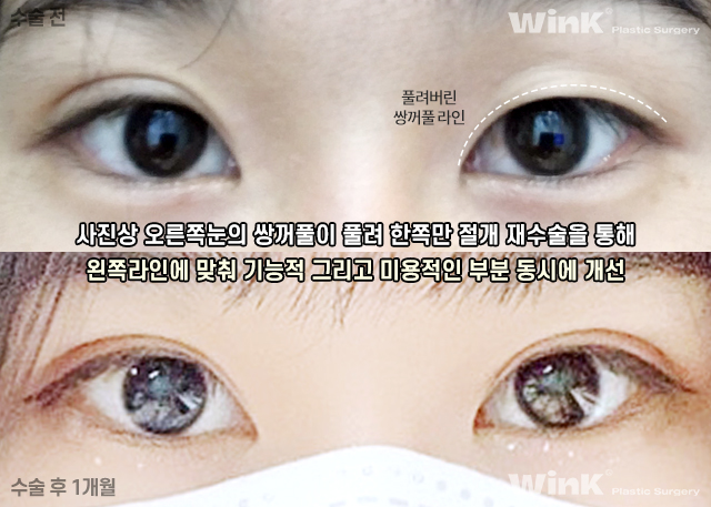 Is It Okay to Have Double Eyelid Surgery on Only One Side? image 6