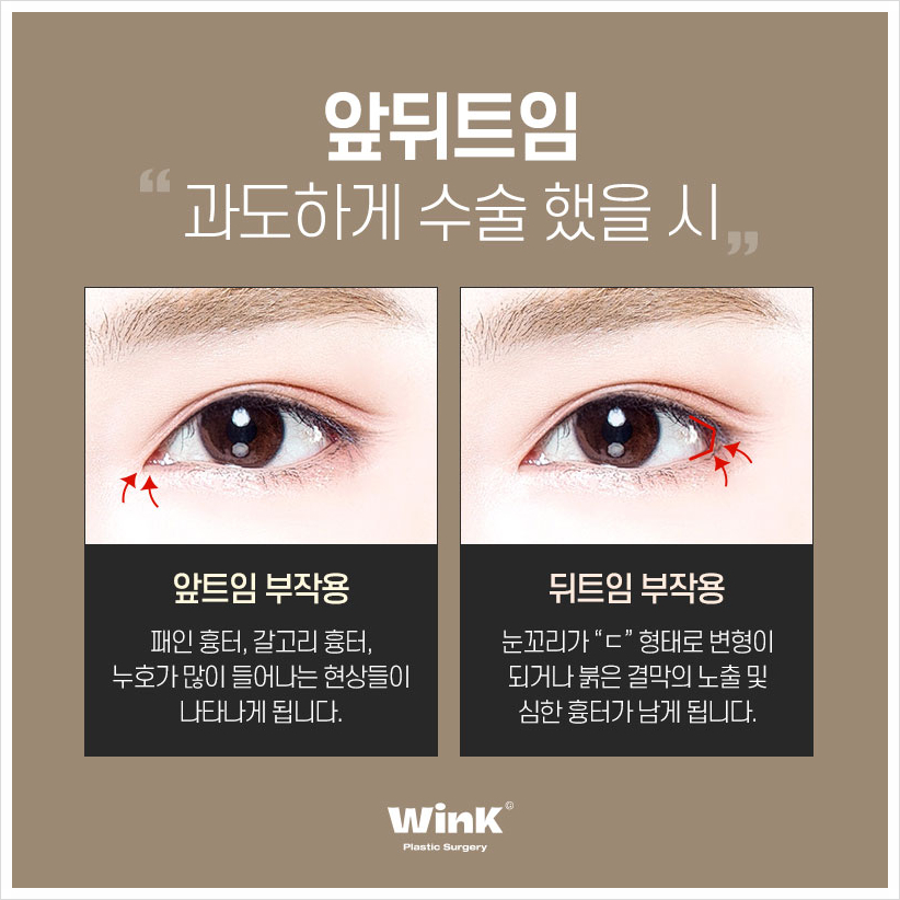 If You’re Looking Into Canthoplasty Revision, WINK Plastic Surgery Medial Canthoplasty Revision Medial Canthoplasty Revision Price Lateral Canthoplasty Reconstruction image 3