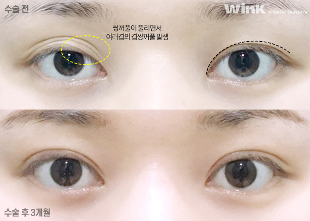 통통한 쌍꺼풀과 겹주름, 해결 방법은? 관련 이미지 7