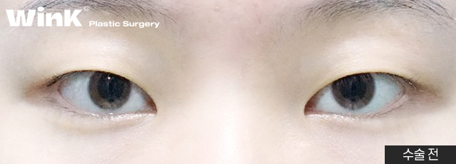 Wink Plastic Surgery’s Non-Incisional Ptosis Correction for Clearer Eyes Without an Incision! image 3