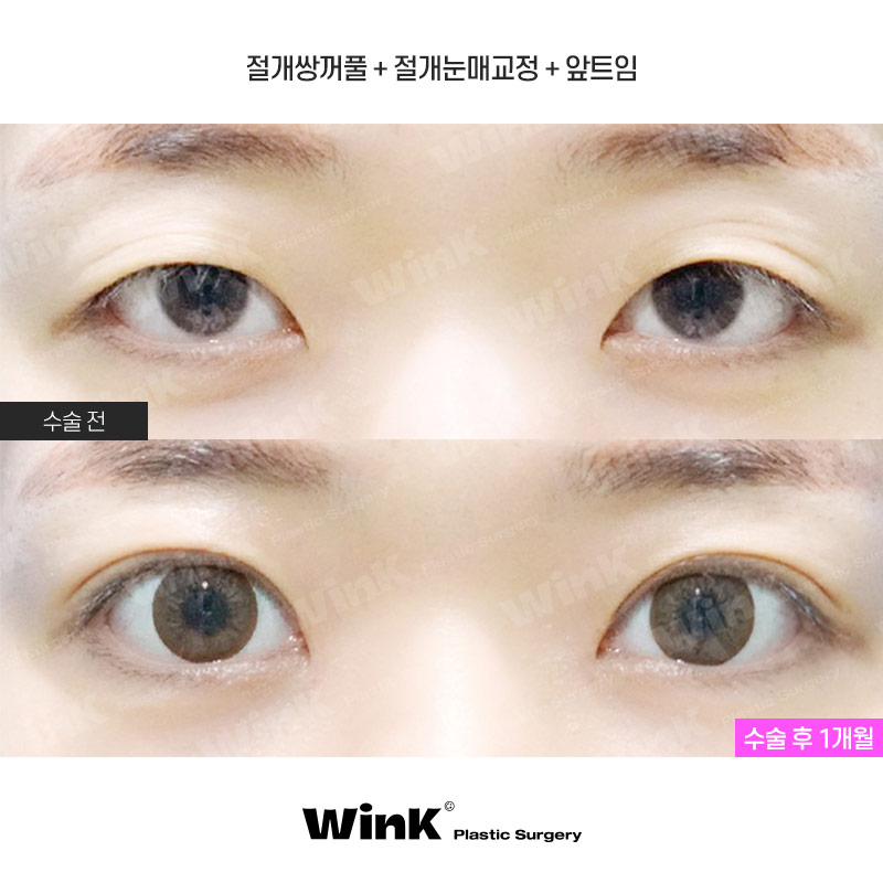 If you want to create the double eyelid line you want without being limited by your eye shape, Wink Incision Double Eyelid Surgery! image 1