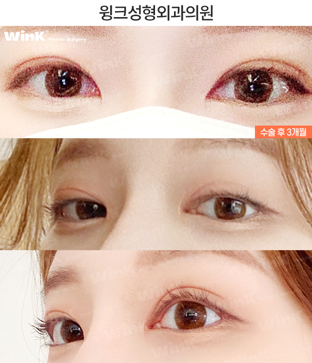 소세지눈 재수술, 두줄따기로 라인 낮추기 관련 이미지 5