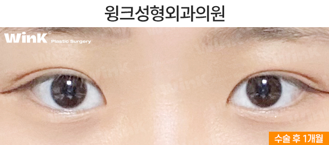 중학생 쌍커풀수술에 대해 알아볼까요? 관련 이미지 3