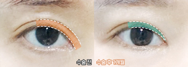Lowering the Double Eyelid Line: Making Thick Double Eyelids (Sausage Eyes) Look Natural with a Two-Line Revision Surgery! image 9