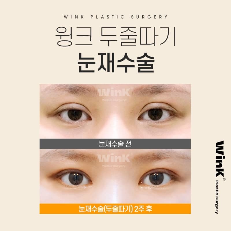 절제 없이 눈재수술 하고 싶다면? 윙크성형외과 두줄따기 눈재수술 관련 이미지 6