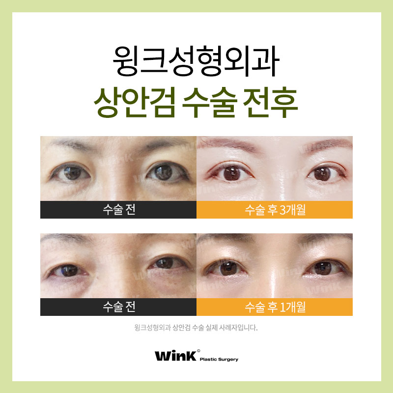 안검내반 윙크성형외과 상안검으로 기능적+미용적 동시에 해결 관련 이미지 7