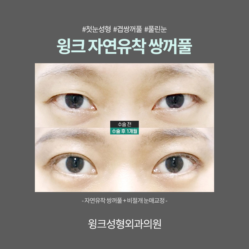 Resolve Double Eyelid Fold Creases with Natural Adhesion for a Clean, Defined Line! image 6