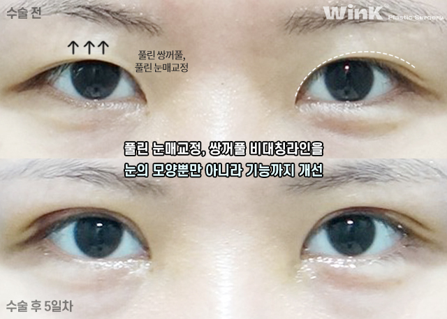 비대칭 안검하수 눈매교정은 어떻게 하는 것일까? 관련 이미지 7