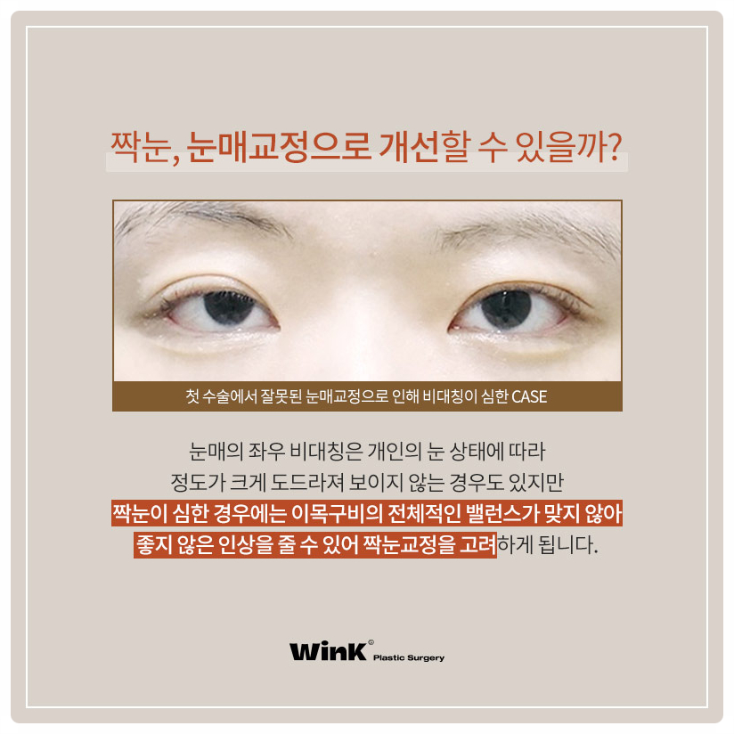 짝눈눈매교정술 잘하는곳? 비대칭짝눈교정 짝눈쌍수 잘하는 윙크성형외과 눈매교정짝눈! 관련 이미지 2