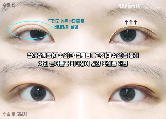 절개 눈매교정 쌍꺼풀 수술에 대해 알아볼까요? 관련 이미지 7
