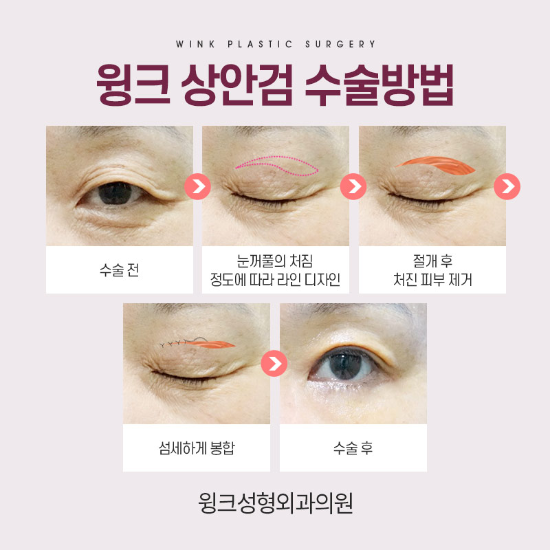 중년눈성형 상안검수술을 알아보자. 관련 이미지 6