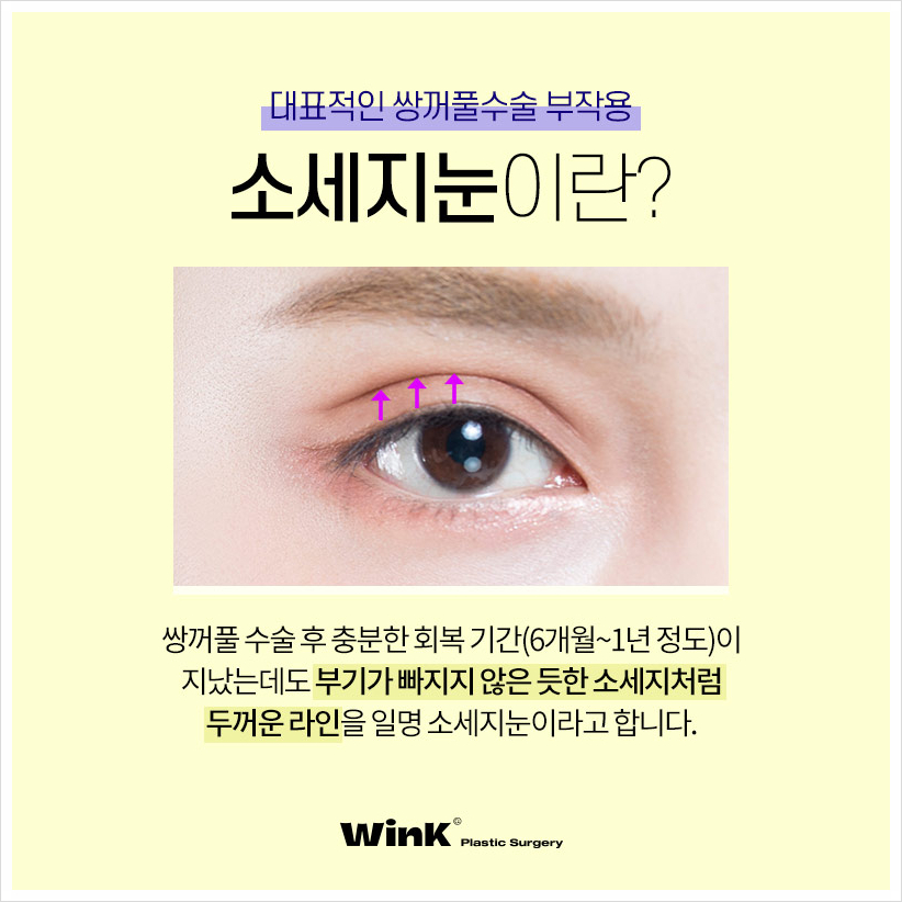 쌍꺼풀재수술 두줄따기눈재수술 윙크성형외과 소세지눈재수술 관련 이미지 2