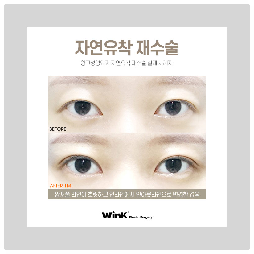 자연유착재수술 신사자연유착비용 신사눈재수술전후 알아본다면 윙크성형외과! 관련 이미지 6