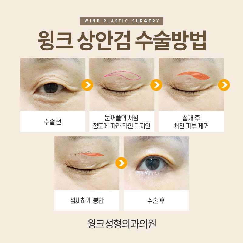 If You Want Upper Eyelid Surgery to Look Natural image 6