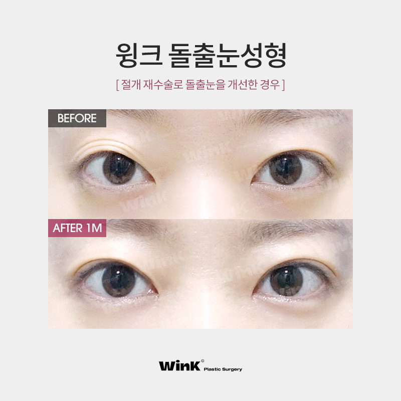 내 눈은 안구가 앞으로 튀어나온 돌출눈? 윙크성형외과에서 알려드리는 돌출눈성형 진단법! 관련 이미지 6