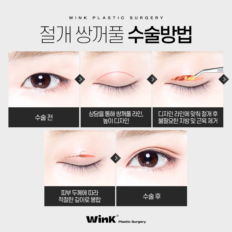 풀릴 걱정 없는 윙크성형외과 절개쌍꺼풀 관련 이미지 4