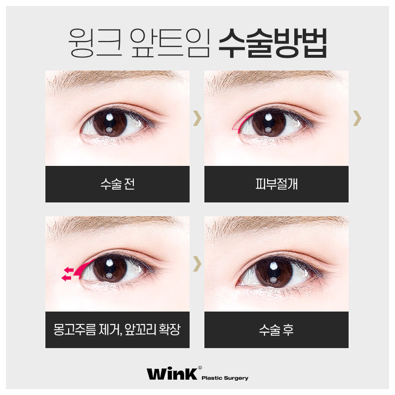 Feeling cramped at the inner corners of your eyes? Make them look refreshed with WINK Plastic Surgery epicanthoplasty! image 4