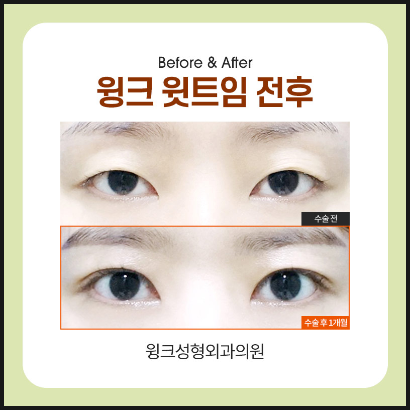 트임성형 윗트임으로 전체적으로 눈을 시원하게! 관련 이미지 5
