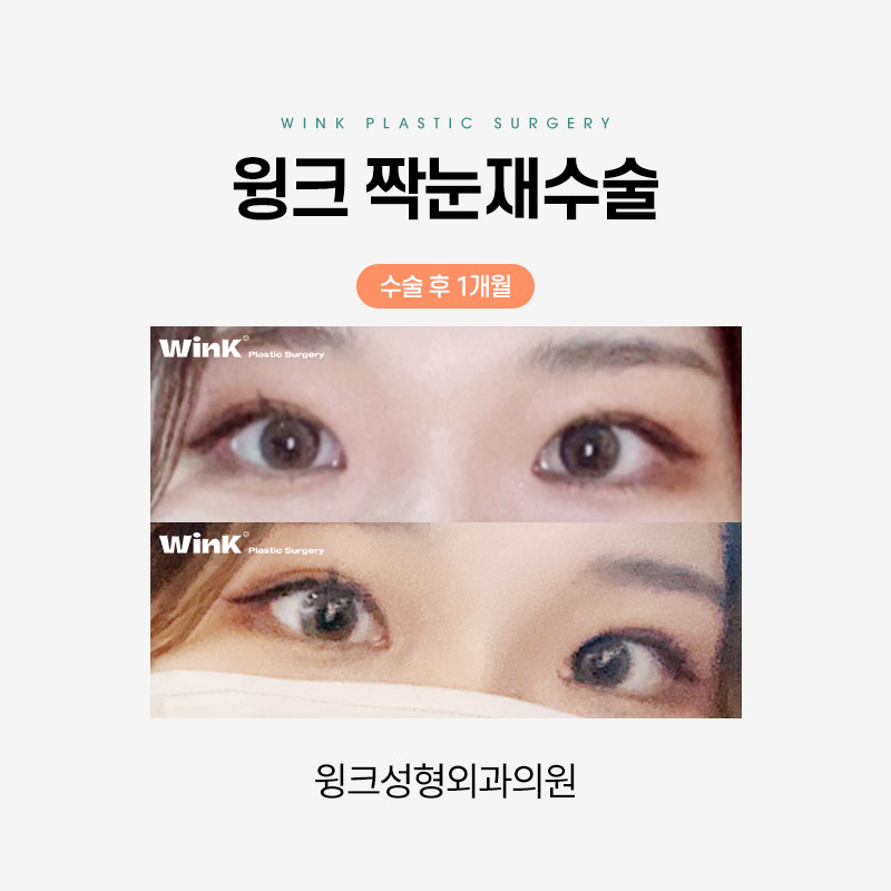 짝눈 쌍꺼풀 재수술에 관해 알아보겠습니다. 관련 이미지 5