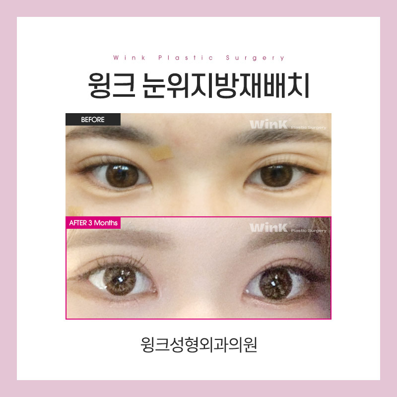 눈위 지방재배치에 대해 알아보겠습니다. 관련 이미지 4