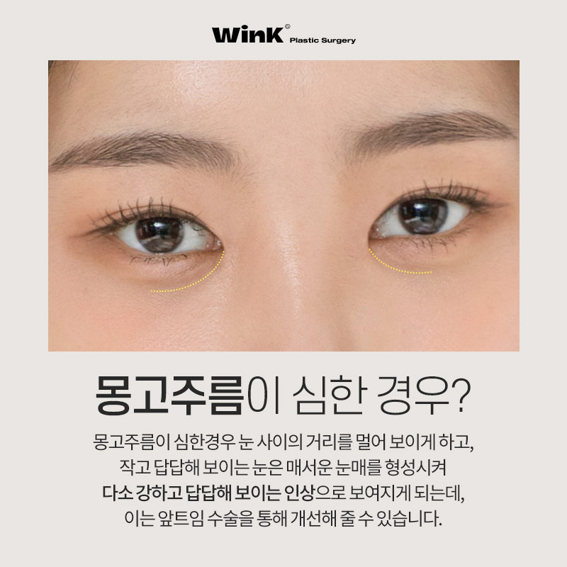 몽고주름이 쌍꺼풀 수술에 미치는 영향! 윙크성형외과에서 알려드려요 관련 이미지 5