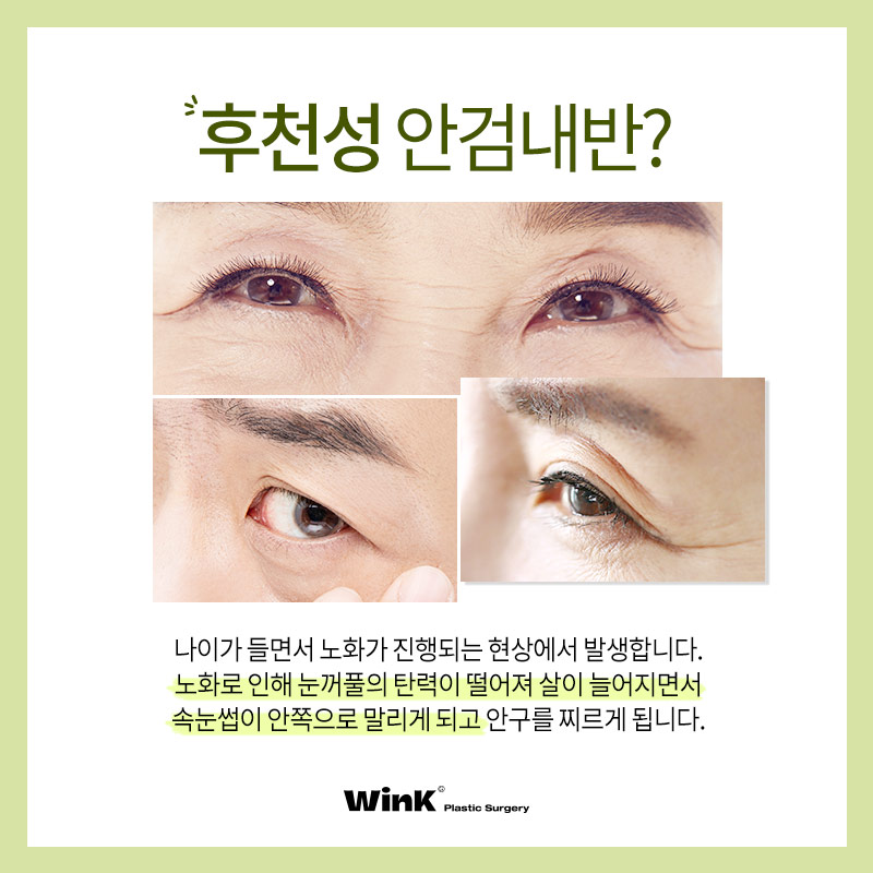 안검내반 윙크성형외과 상안검으로 기능적+미용적 동시에 해결 관련 이미지 3