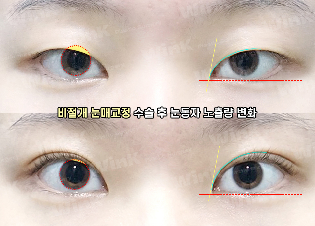 Wink Plastic Surgery’s Non-Incisional Ptosis Correction for Clearer Eyes Without an Incision! image 6