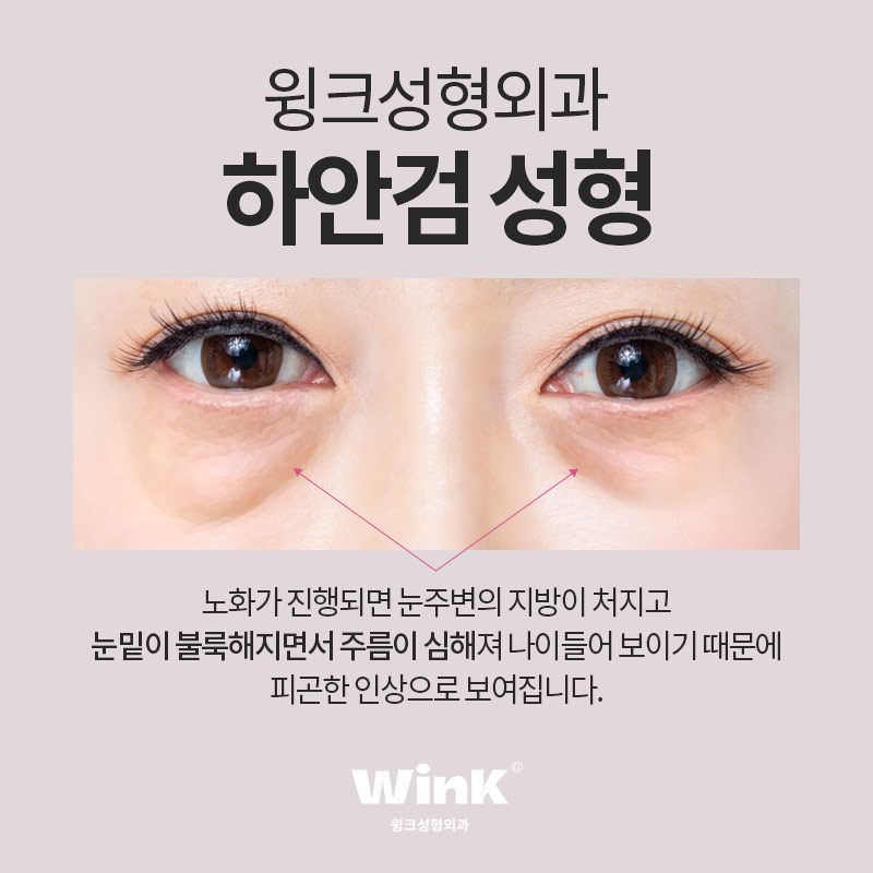 하안검 수술로 생기 있고 환한 동안 눈매로 관련 이미지 2