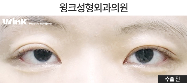 절개 눈매교정 쌍꺼풀 수술에 대해 알아볼까요? 관련 이미지 5