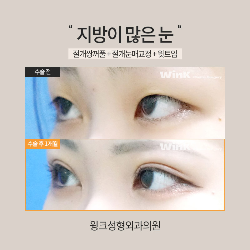 How Is Double Eyelid Surgery Performed on Eyes with a Lot of Fat? image 6
