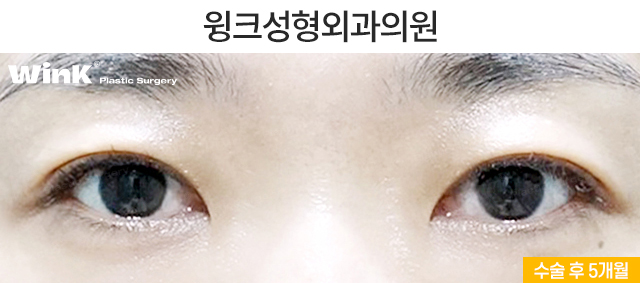 About Upper Eyelid Surgery for Middle-Aged Patients image 3