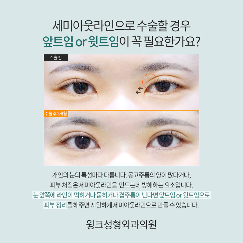 세미아웃 연예인 누가 있을까? 관련 이미지 4