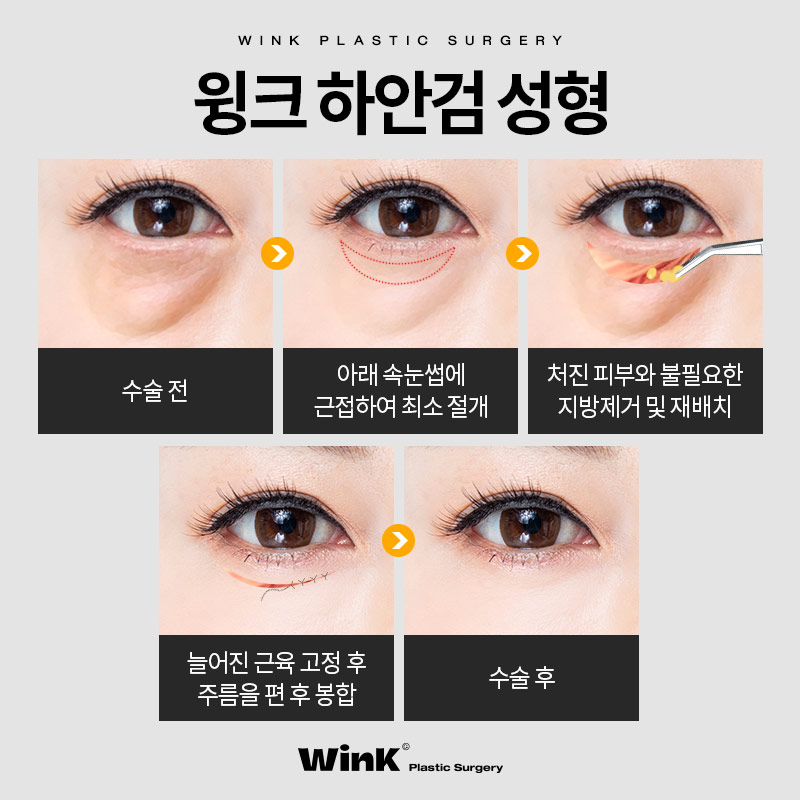 눈밑주름제거수술 눈밑주름에는  윙크성형외과 하안검수술후기 관련 이미지 4