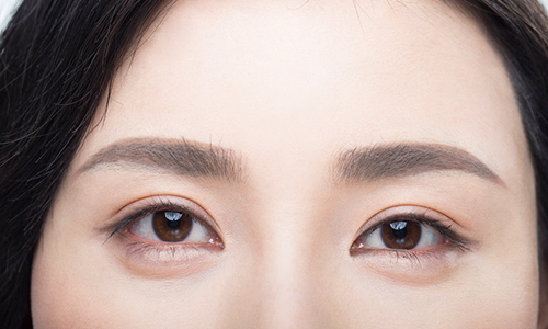 상안검 수술, 자연스러운 결과를 얻으려면 관련 이미지 4