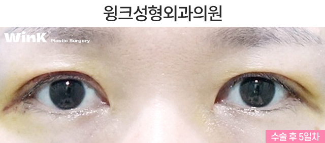 비대칭 안검하수 눈매교정은 어떻게 하는 것일까? 관련 이미지 3