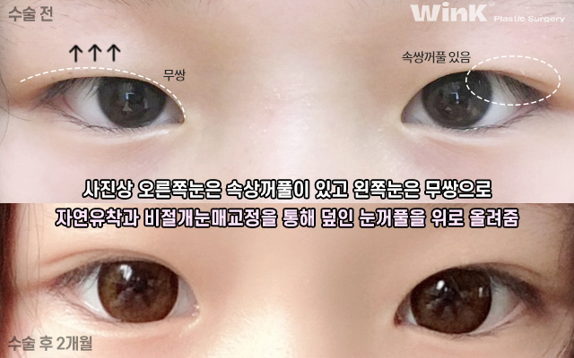 중학생 쌍커풀수술에 대해 알아볼까요? 관련 이미지 13