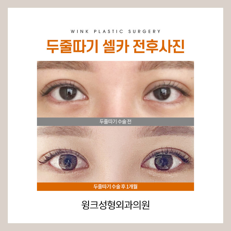 Let’s take a look at the differences before and after line lowering. image 5