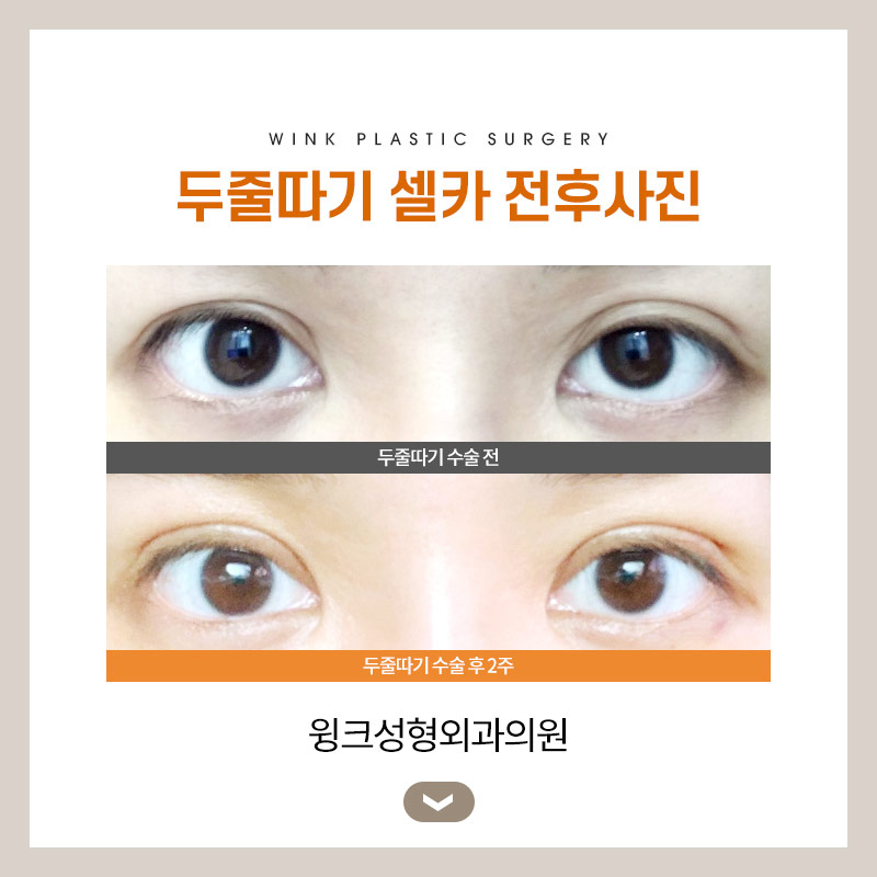 Let’s take a look at the differences before and after line lowering. image 6