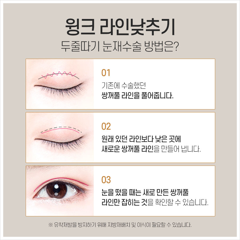 신사두줄따기 윙크성형외과 쌍꺼풀풀기 쌍꺼풀라인낮추기 소세지쌍꺼풀재수술 관련 이미지 4