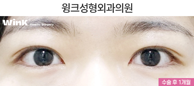 Should We Leave Eyelid Tape and Eyelid Glue Behind with Natural Adhesion Double Eyelid Surgery? image 6