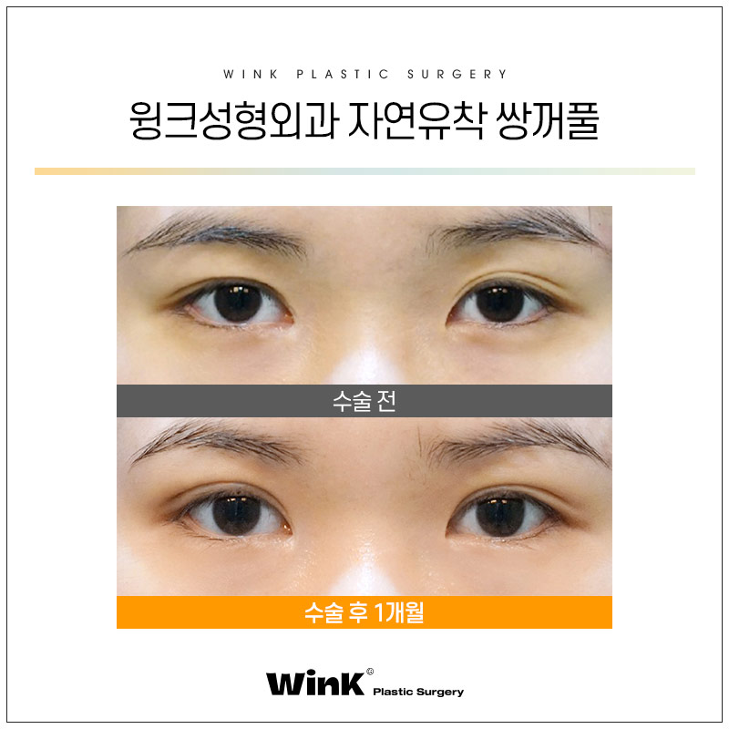 윙크성형외과에서 알려드리는 눈성형의 모든것! 관련 이미지 3