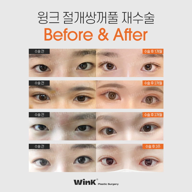 눈을 떠도, 눈을 감아도 자연스러운 윙크성형외과 절개쌍꺼풀 재수술 관련 이미지 8