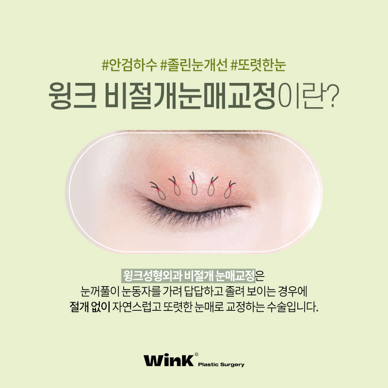 Sinsa Station Eye Correction Review | Sinsa Eye Correction Specialist | Wink Plastic Surgery | Non-Incisional Eye Correction image 5