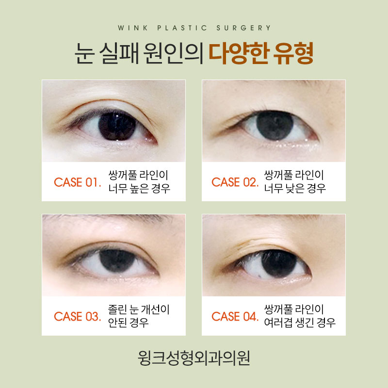 Let’s Take a Look at What to Consider When Undergoing Revision Double Eyelid Surgery. image 3