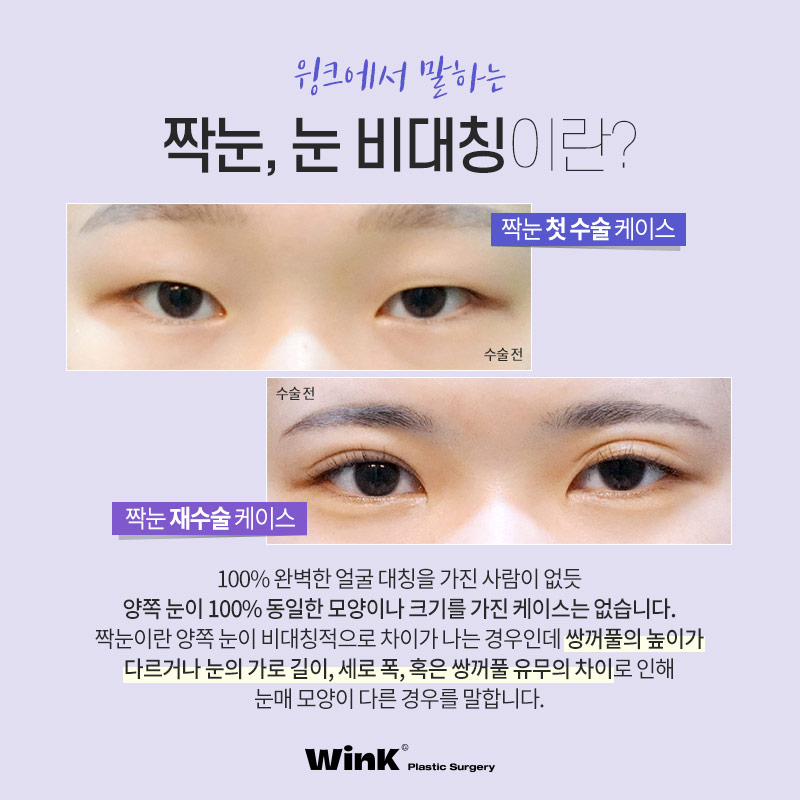 Asymmetrical Eyes and Eye Asymmetry Correction Explained by Wink Plastic Surgery image 2
